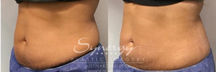 Before & After CoolSculpting® Case 856 Right Oblique View in Austin, TX
