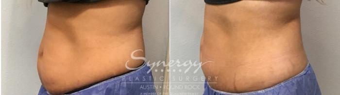 Before & After CoolSculpting® Case 856 Right Side View in Austin, TX