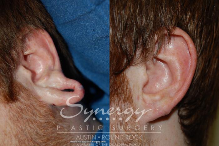 Before & After Ear Lobe Repair Case 174 View #1 View in Austin, TX