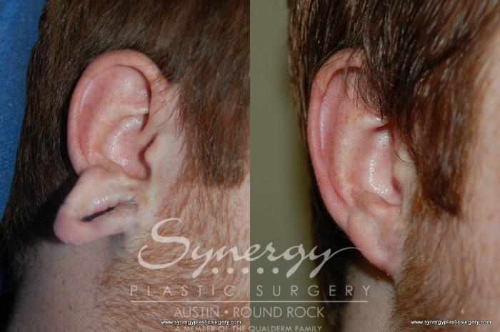 Before & After Ear Lobe Repair Case 174 View #2 View in Austin, TX