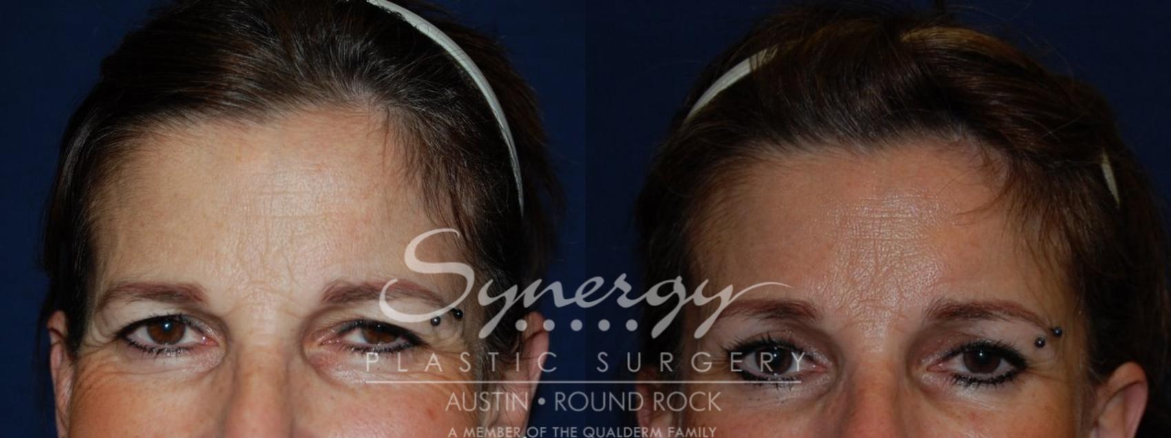 Before & After Endoscopic Brow Lift/Upper Eyelid Surgery Case 122 View #1 View in Round Rock, TX
