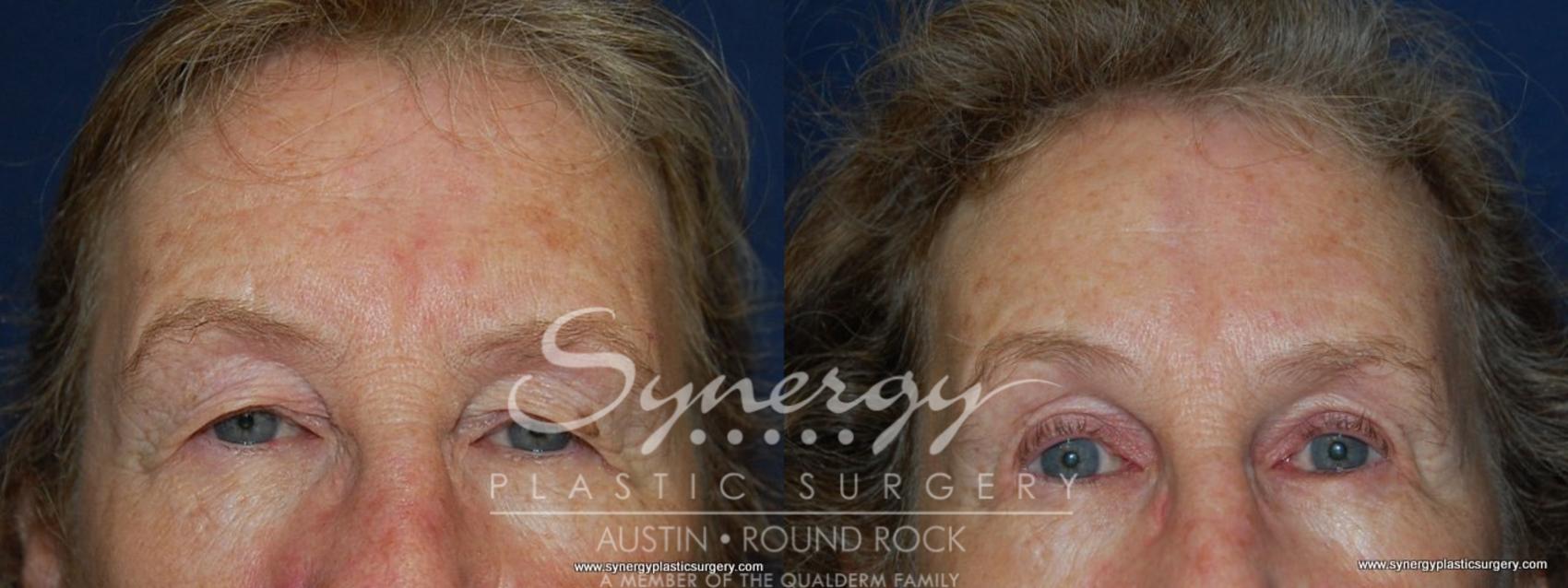 Before & After Endoscopic Brow Lift/Upper Eyelid Surgery Case 145 View #1 View in Round Rock, TX
