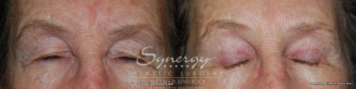 Before & After Endoscopic Brow Lift/Upper Eyelid Surgery Case 145 View #2 View in Austin, TX