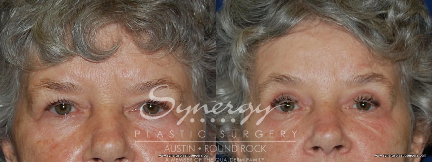 Before & After Endoscopic Brow Lift/Upper Eyelid Surgery Case 183 View #1 View in Round Rock, TX