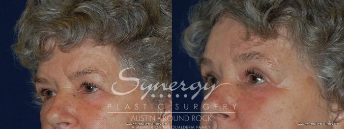 Before & After Endoscopic Brow Lift/Upper Eyelid Surgery Case 183 View #2 View in Austin, TX