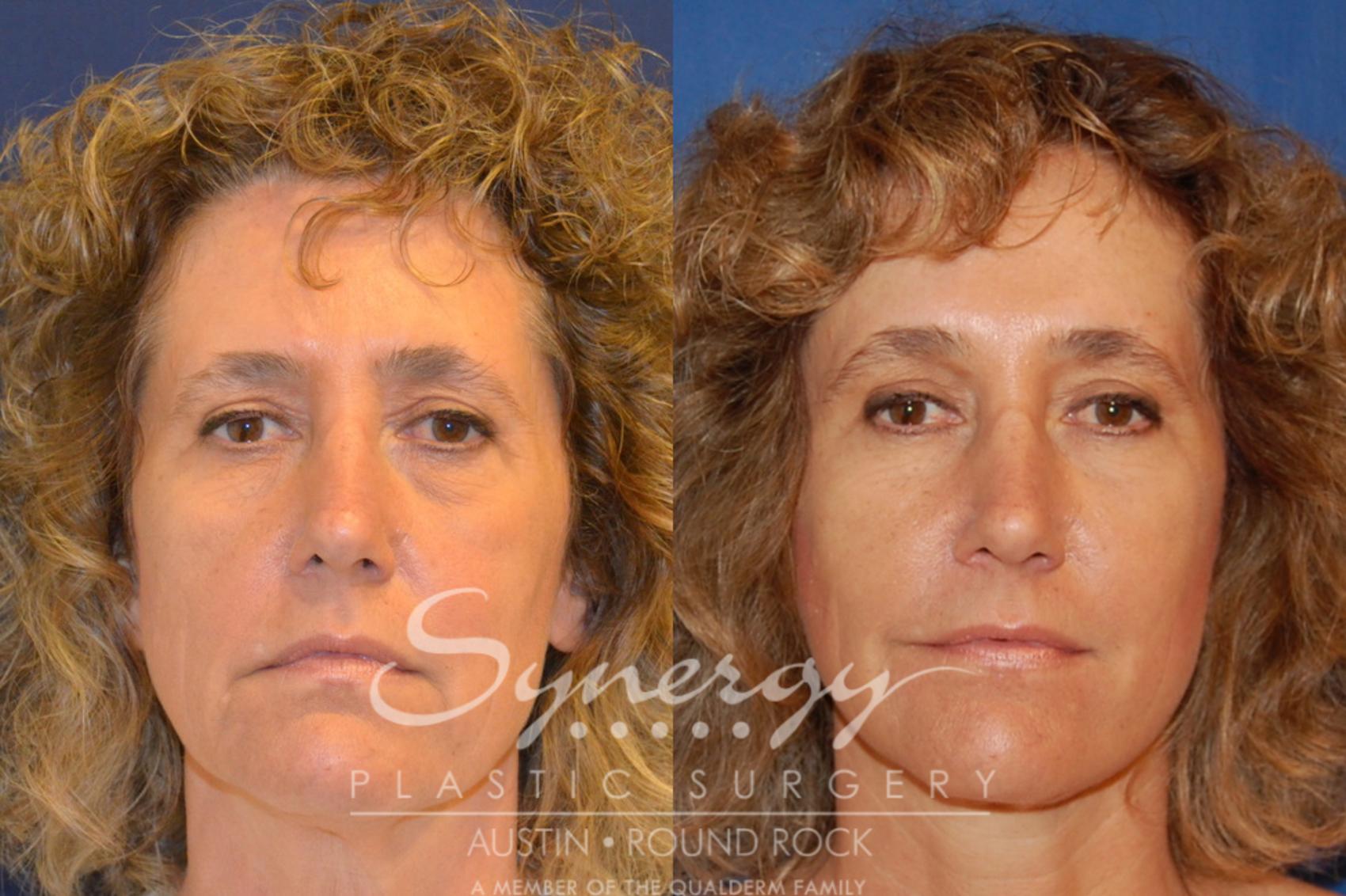 Before & After Endoscopic Brow Lift/Upper Eyelid Surgery Case 303 View #1 View in Round Rock, TX