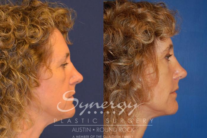 Before & After Endoscopic Brow Lift/Upper Eyelid Surgery Case 303 View #2 View in Austin, TX