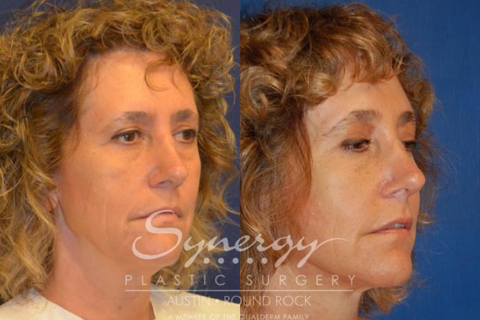 Before & After Endoscopic Brow Lift/Upper Eyelid Surgery Case 303 View #3 View in Austin, TX