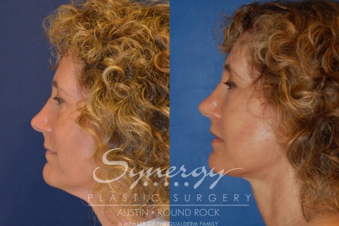 Before & After Endoscopic Brow Lift/Upper Eyelid Surgery Case 303 View #4 View in Austin, TX
