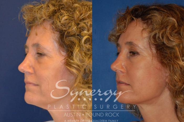 Before & After Endoscopic Brow Lift/Upper Eyelid Surgery Case 303 View #5 View in Austin, TX