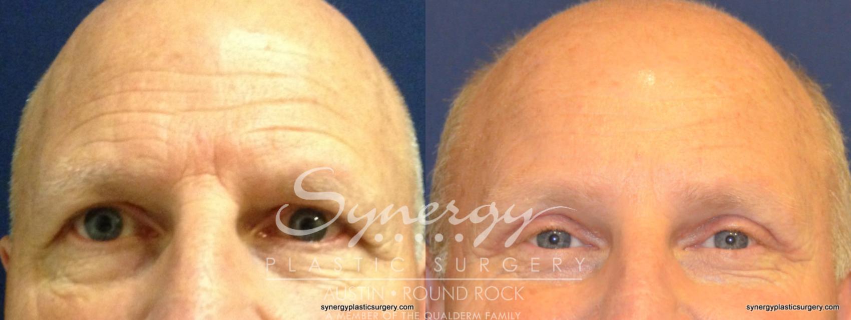 Before & After Endoscopic Brow Lift/Upper Eyelid Surgery Case 345 View #1 View in Round Rock, TX