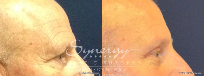 Before & After Endoscopic Brow Lift/Upper Eyelid Surgery Case 345 View #2 View in Austin, TX
