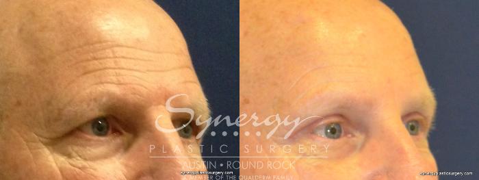 Before & After Endoscopic Brow Lift/Upper Eyelid Surgery Case 345 View #3 View in Austin, TX