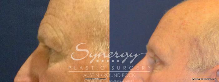 Before & After Endoscopic Brow Lift/Upper Eyelid Surgery Case 345 View #4 View in Austin, TX