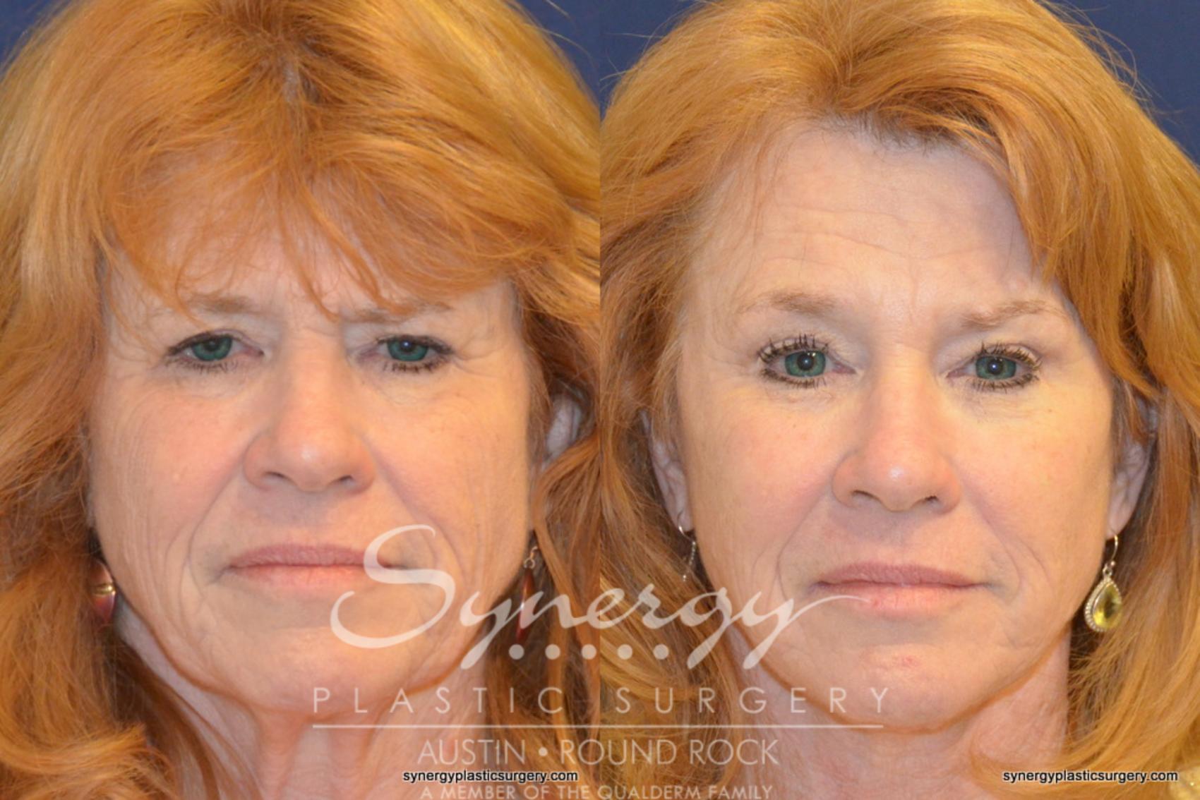 Before & After Endoscopic Brow Lift/Upper Eyelid Surgery Case 348 View #1 View in Round Rock, TX
