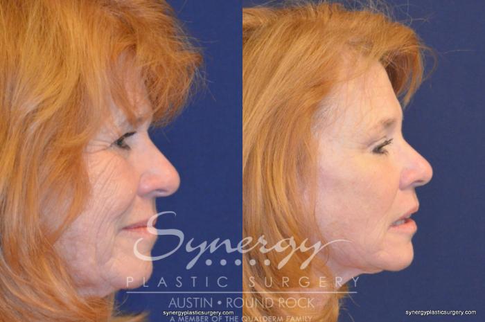 Before & After Endoscopic Brow Lift/Upper Eyelid Surgery Case 348 View #2 View in Austin, TX