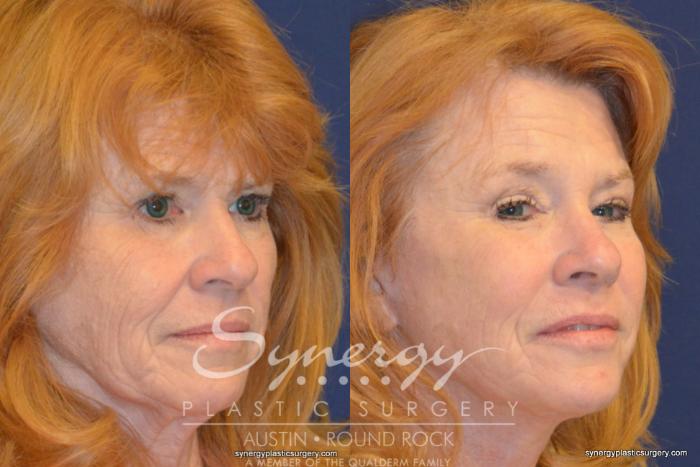 Before & After Endoscopic Brow Lift/Upper Eyelid Surgery Case 348 View #3 View in Austin, TX