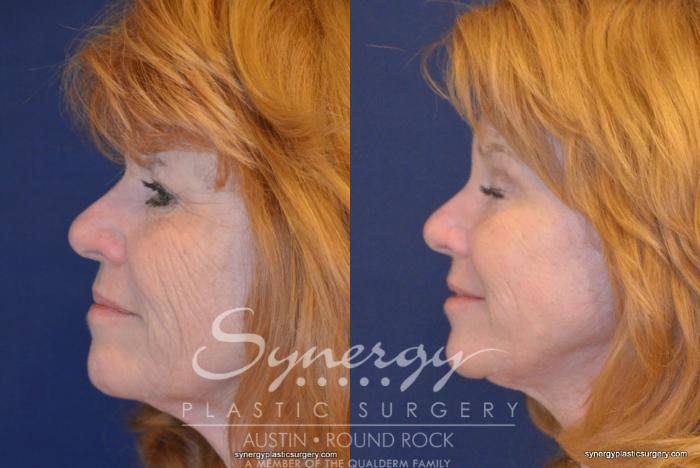Before & After Endoscopic Brow Lift/Upper Eyelid Surgery Case 348 View #4 View in Austin, TX
