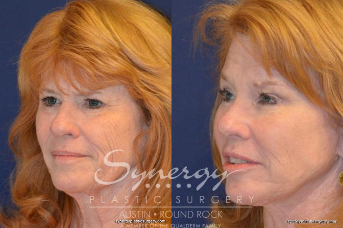 Before & After Endoscopic Brow Lift/Upper Eyelid Surgery Case 348 View #5 View in Austin, TX