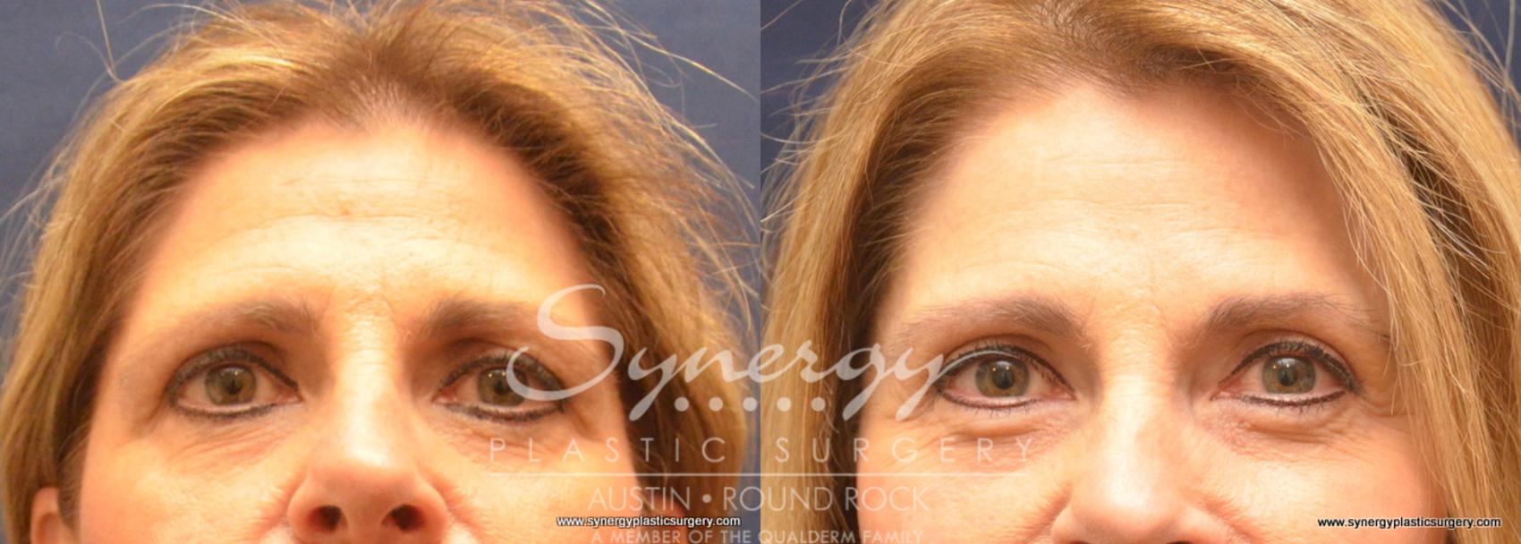 Before & After Endoscopic Brow Lift/Upper Eyelid Surgery Case 742 View #1 View in Round Rock, TX