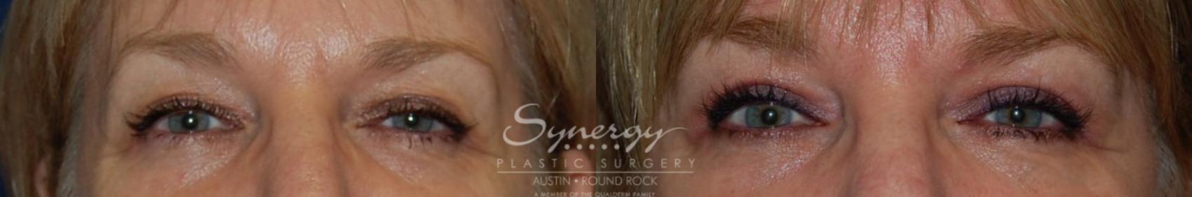 Before & After Eyelid Surgery (Blepharoplasty) Case 130 View #1 View in Round Rock, TX