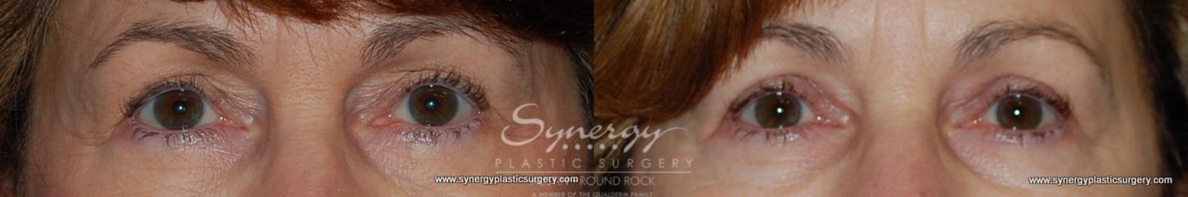 Before & After Eyelid Surgery (Blepharoplasty) Case 167 View #1 View in Round Rock, TX