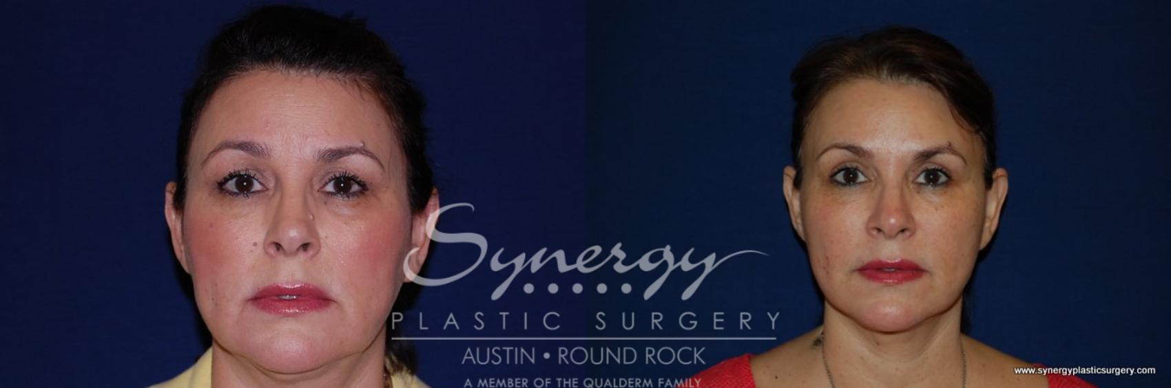 Before & After Eyelid Surgery (Blepharoplasty) Case 193 View #1 View in Round Rock, TX