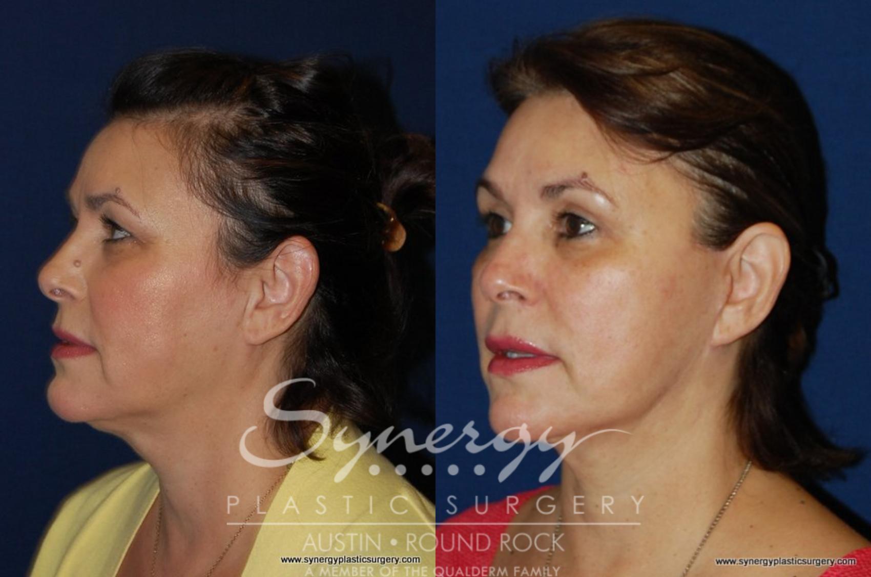Before & After Eyelid Surgery (Blepharoplasty) Case 193 View #2 View in Round Rock, TX
