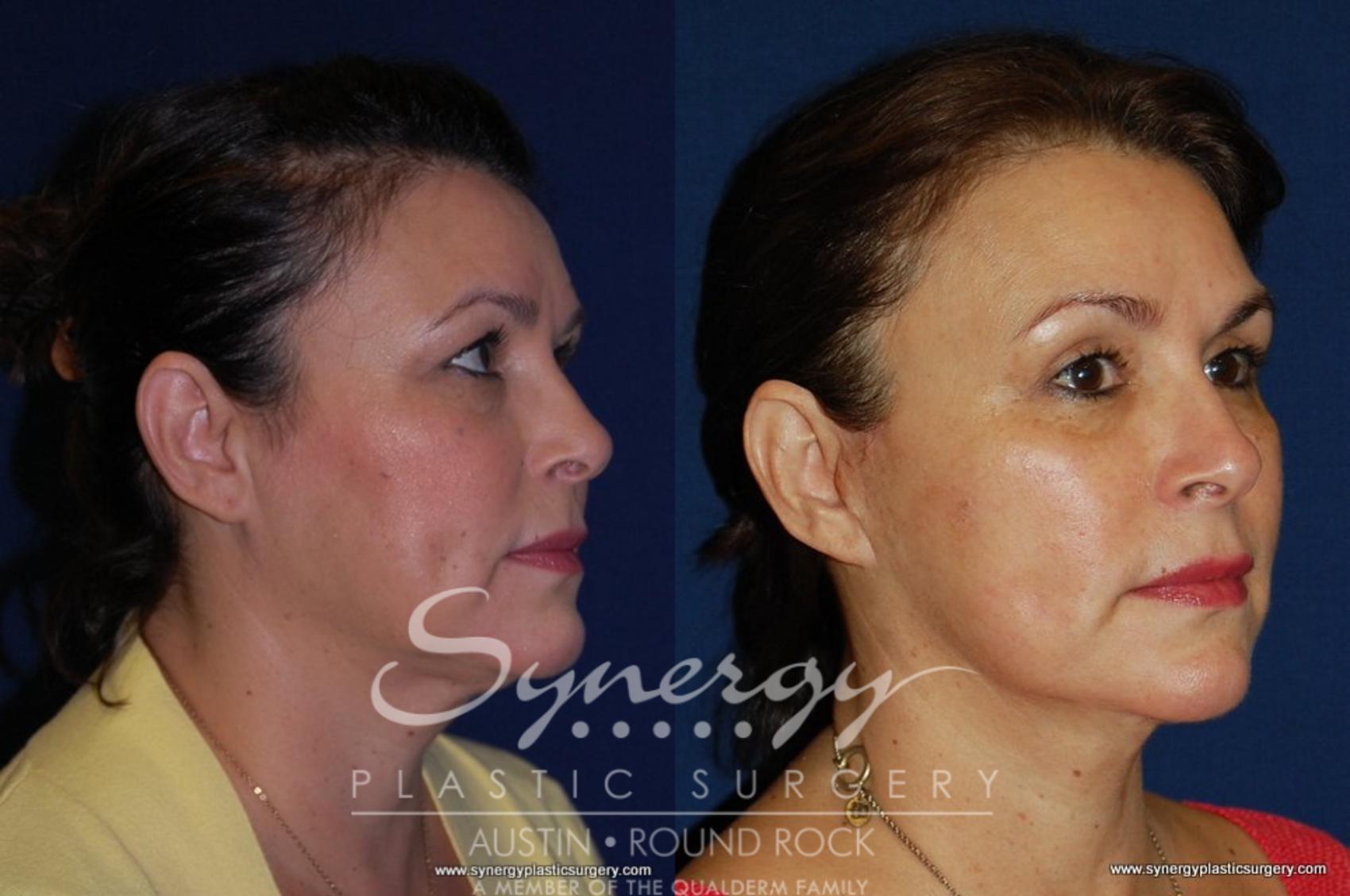 Before & After Eyelid Surgery (Blepharoplasty) Case 193 View #3 View in Round Rock, TX