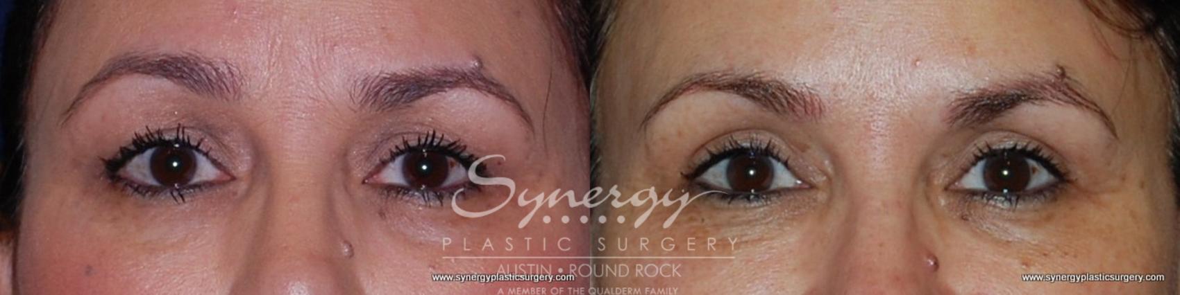 Before & After Eyelid Surgery (Blepharoplasty) Case 193 View #4 View in Round Rock, TX