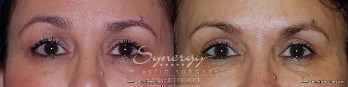 Before & After Eyelid Surgery (Blepharoplasty) Case 193 View #4 View in Austin, TX