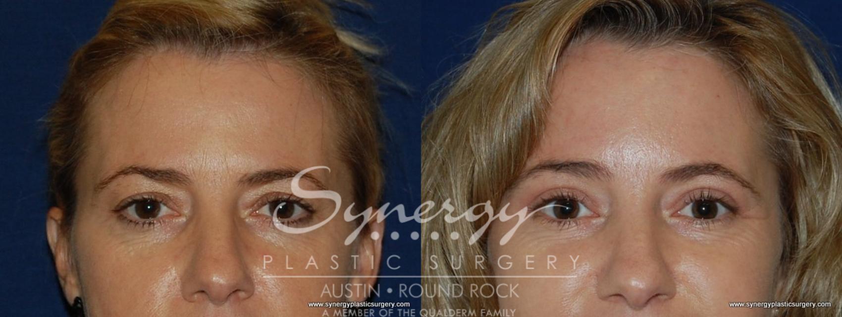 Before & After Eyelid Surgery (Blepharoplasty) Case 195 View #1 View in Round Rock, TX