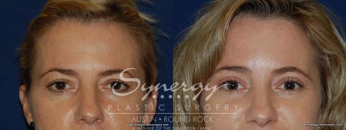 Before & After Eyelid Surgery (Blepharoplasty) Case 195 View #1 View in Austin, TX