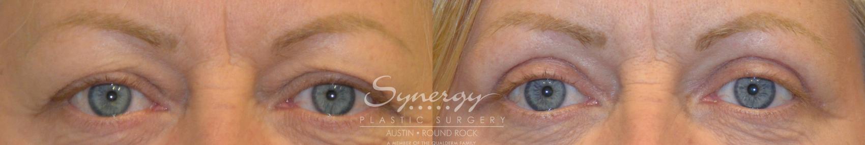 Before & After Eyelid Surgery (Blepharoplasty) Case 202 View #1 View in Round Rock, TX