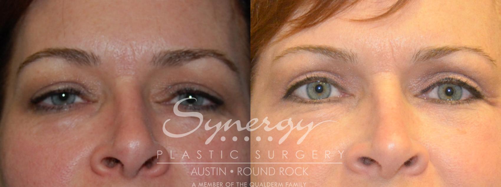 Before & After Eyelid Surgery (Blepharoplasty) Case 206 View #1 View in Round Rock, TX