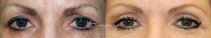 Before & After Eyelid Surgery (Blepharoplasty) Case 25 View #1 View in Austin, TX