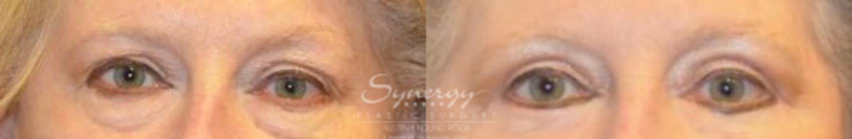 Before & After Eyelid Surgery (Blepharoplasty) Case 272 View #1 View in Round Rock, TX
