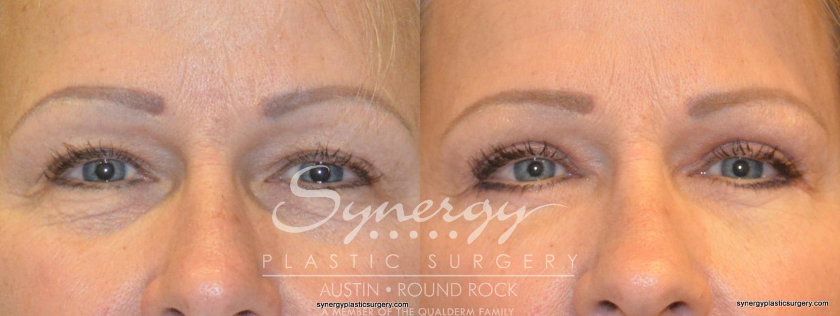 Before & After Eyelid Surgery (Blepharoplasty) Case 273 View #1 View in Round Rock, TX