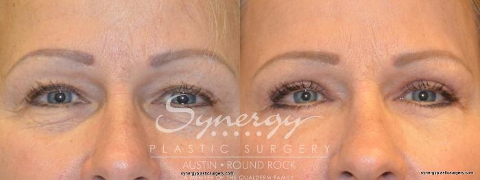 Before & After Eyelid Surgery (Blepharoplasty) Case 273 View #1 View in Austin, TX