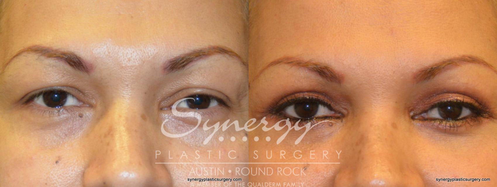 Before & After Eyelid Surgery (Blepharoplasty) Case 278 View #1 View in Round Rock, TX