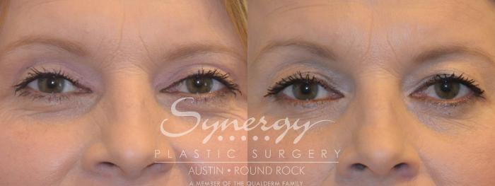 Before & After Eyelid Surgery (Blepharoplasty) Case 315 View #1 View in Austin, TX