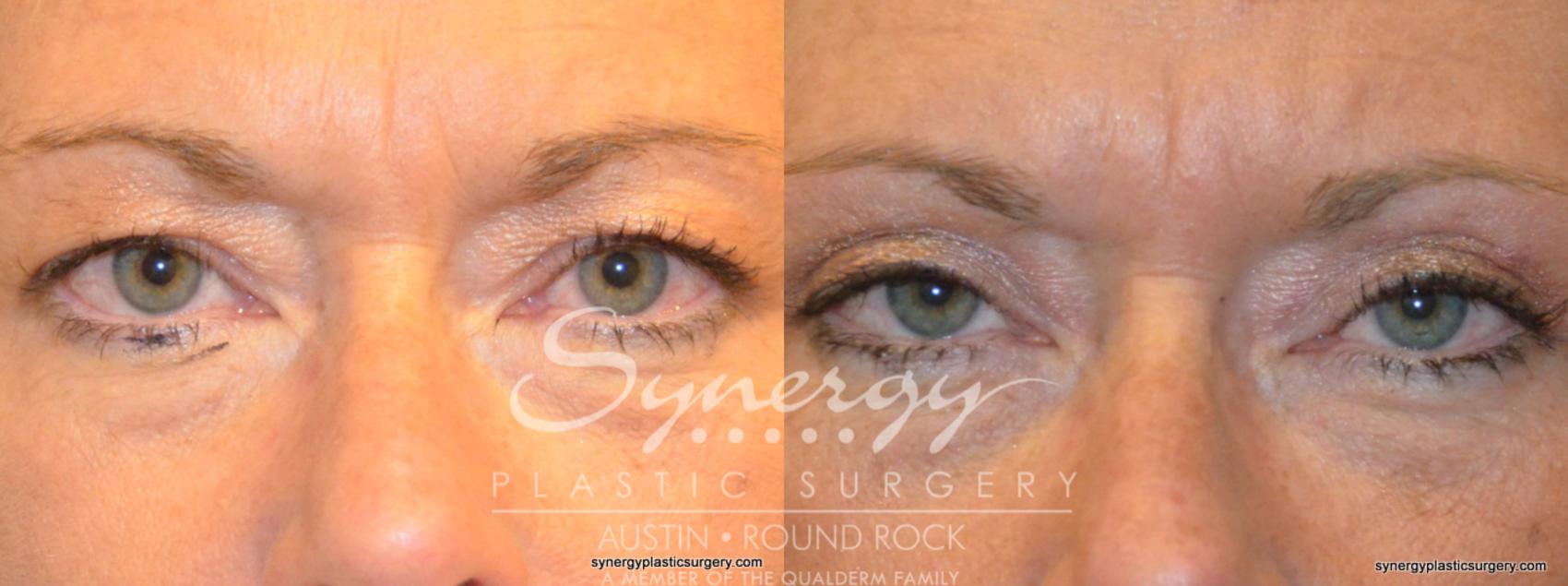 Before & After Eyelid Surgery (Blepharoplasty) Case 319 View #1 View in Round Rock, TX