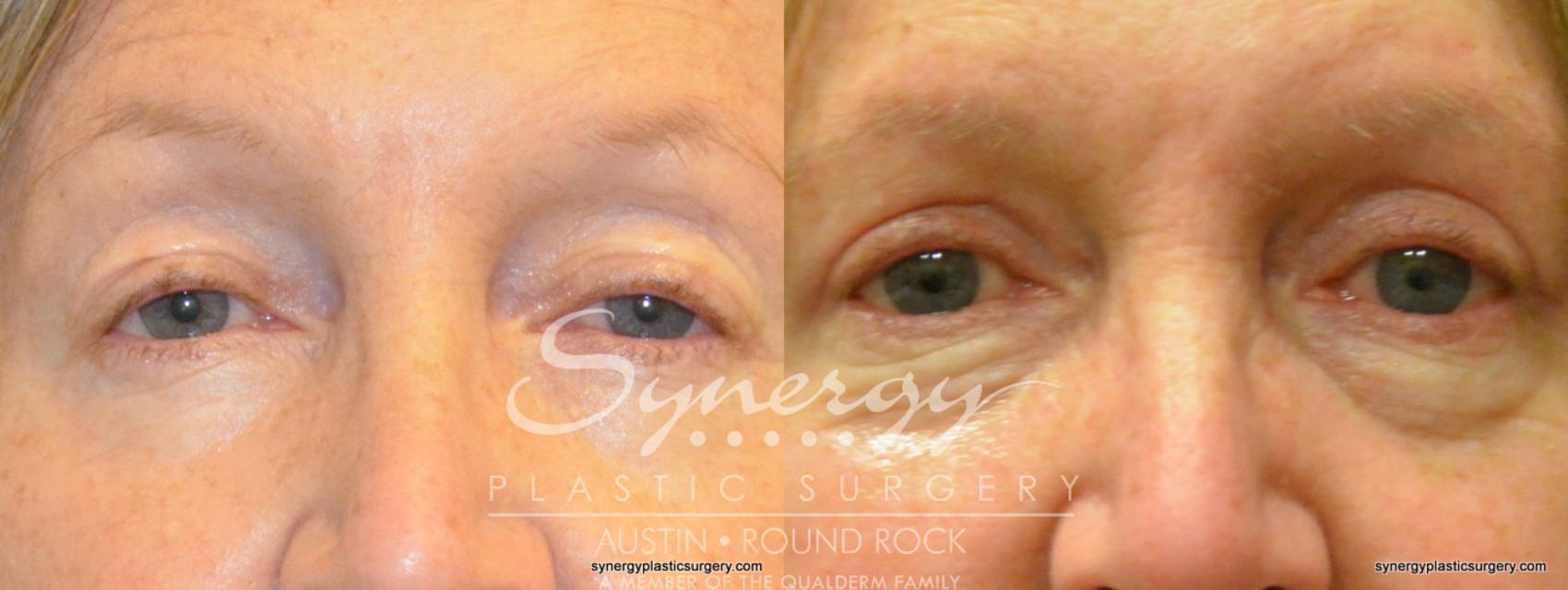 Before & After Eyelid Surgery (Blepharoplasty) Case 366 View #1 View in Austin, TX