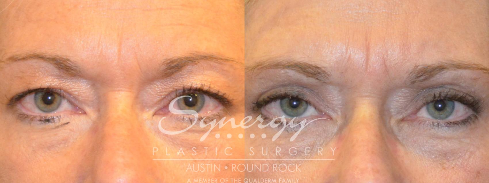 Before & After Eyelid Surgery (Blepharoplasty) Case 381 View #1 View in Round Rock, TX