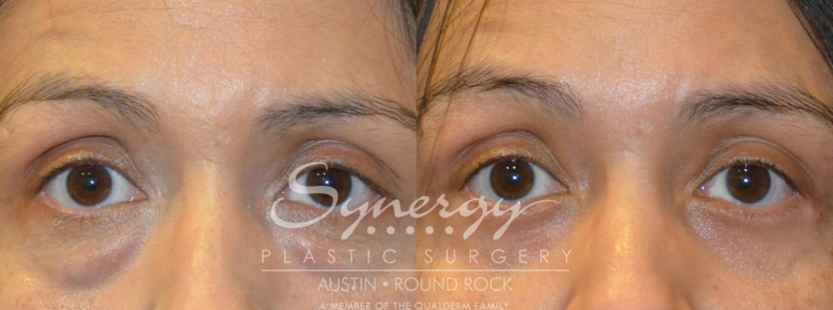 Before & After Eyelid Surgery (Blepharoplasty) Case 382 View #1 View in Round Rock, TX