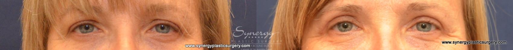 Before & After Eyelid Surgery (Blepharoplasty) Case 574 View #1 View in Round Rock, TX