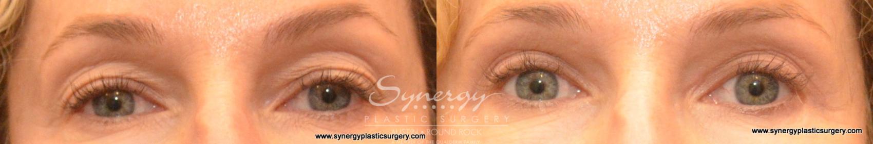 Before & After Eyelid Surgery (Blepharoplasty) Case 578 View #1 View in Round Rock, TX