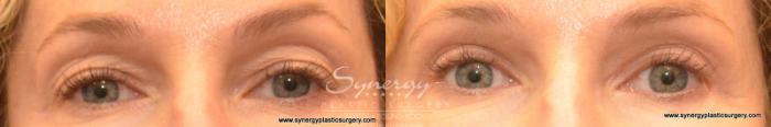 Before & After Eyelid Surgery (Blepharoplasty) Case 578 View #1 View in Austin, TX