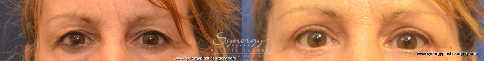 Before & After Eyelid Surgery (Blepharoplasty) Case 591 View #1 View in Round Rock, TX