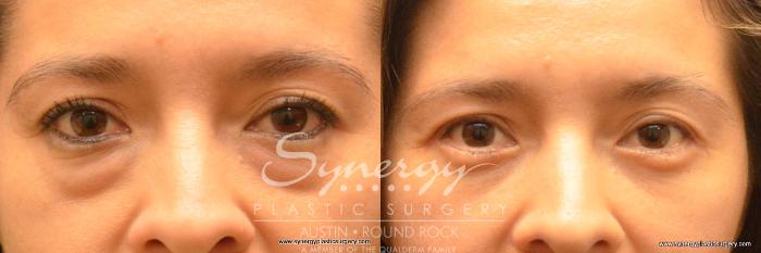 Before & After Eyelid Surgery (Blepharoplasty) Case 655 View #1 View in Austin, TX